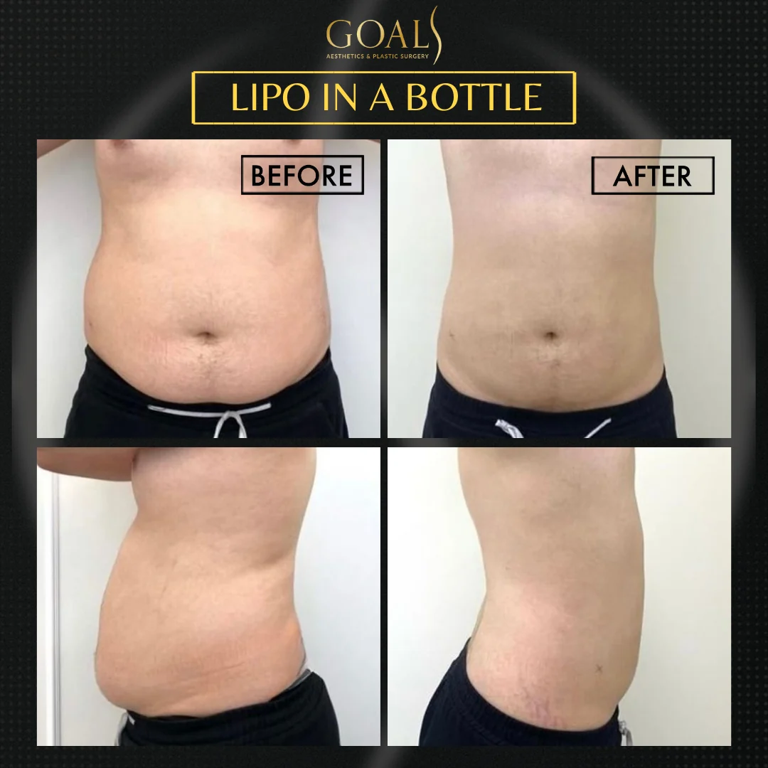 Before and after — Fat Loss Shots · Atlanta Tucker Rd., patient 2