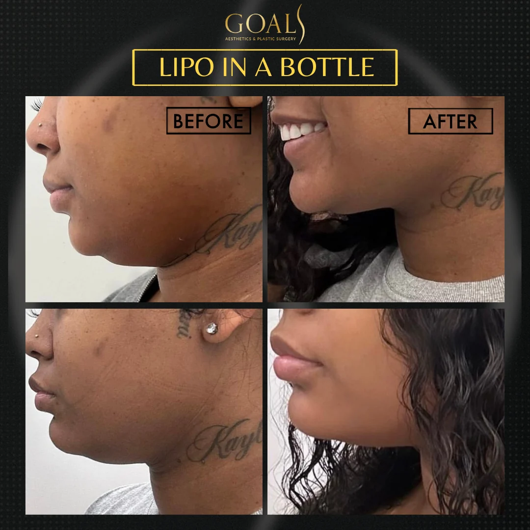 Before and after — Fat Loss Shots, patient 1