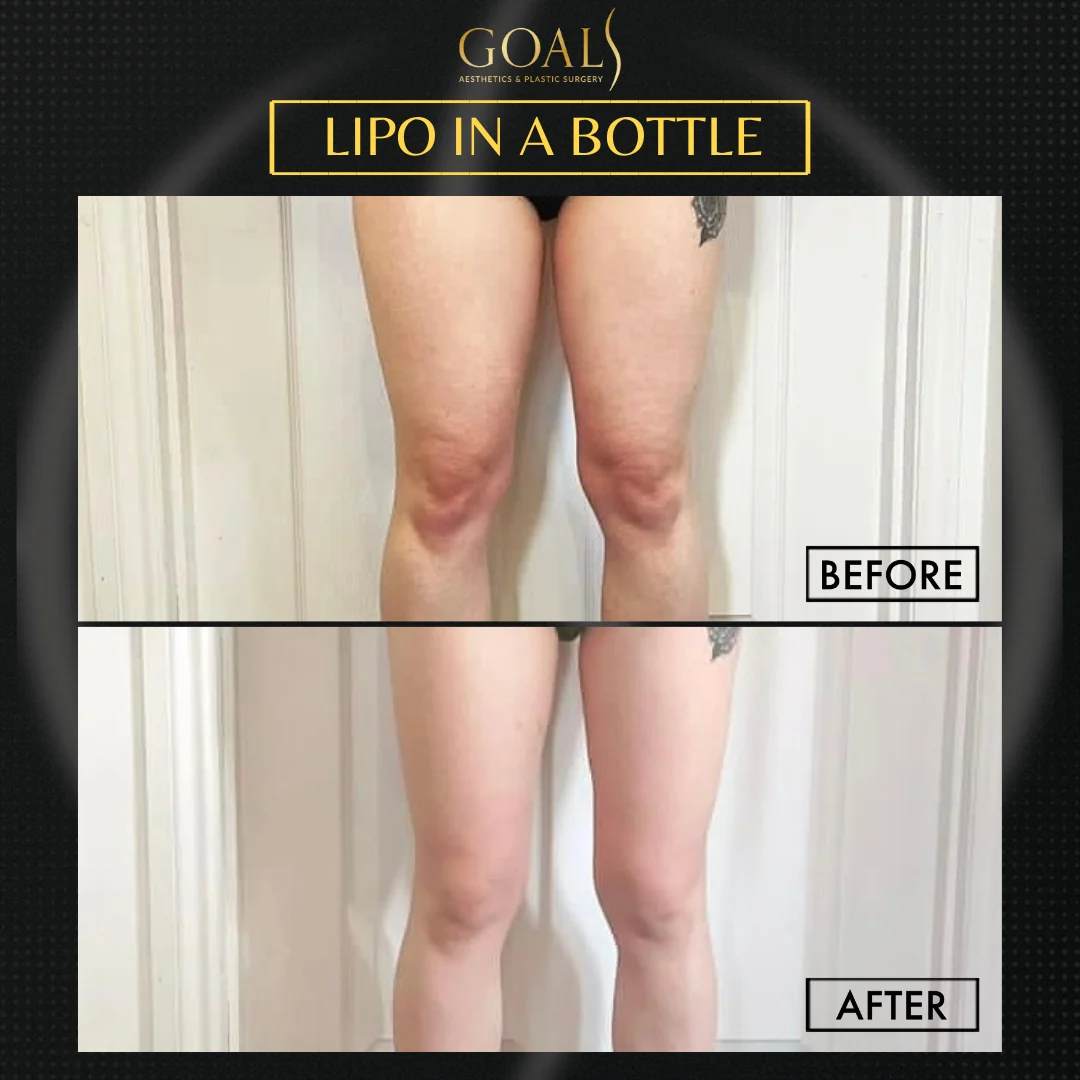 Before and after — Fat Loss Shots, patient 2