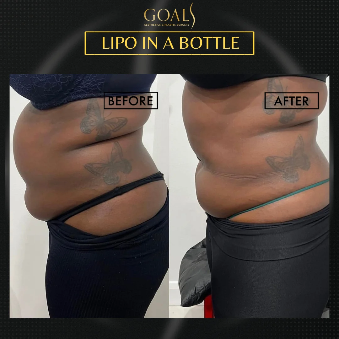 Before and after — Fat Loss Shots, patient 3