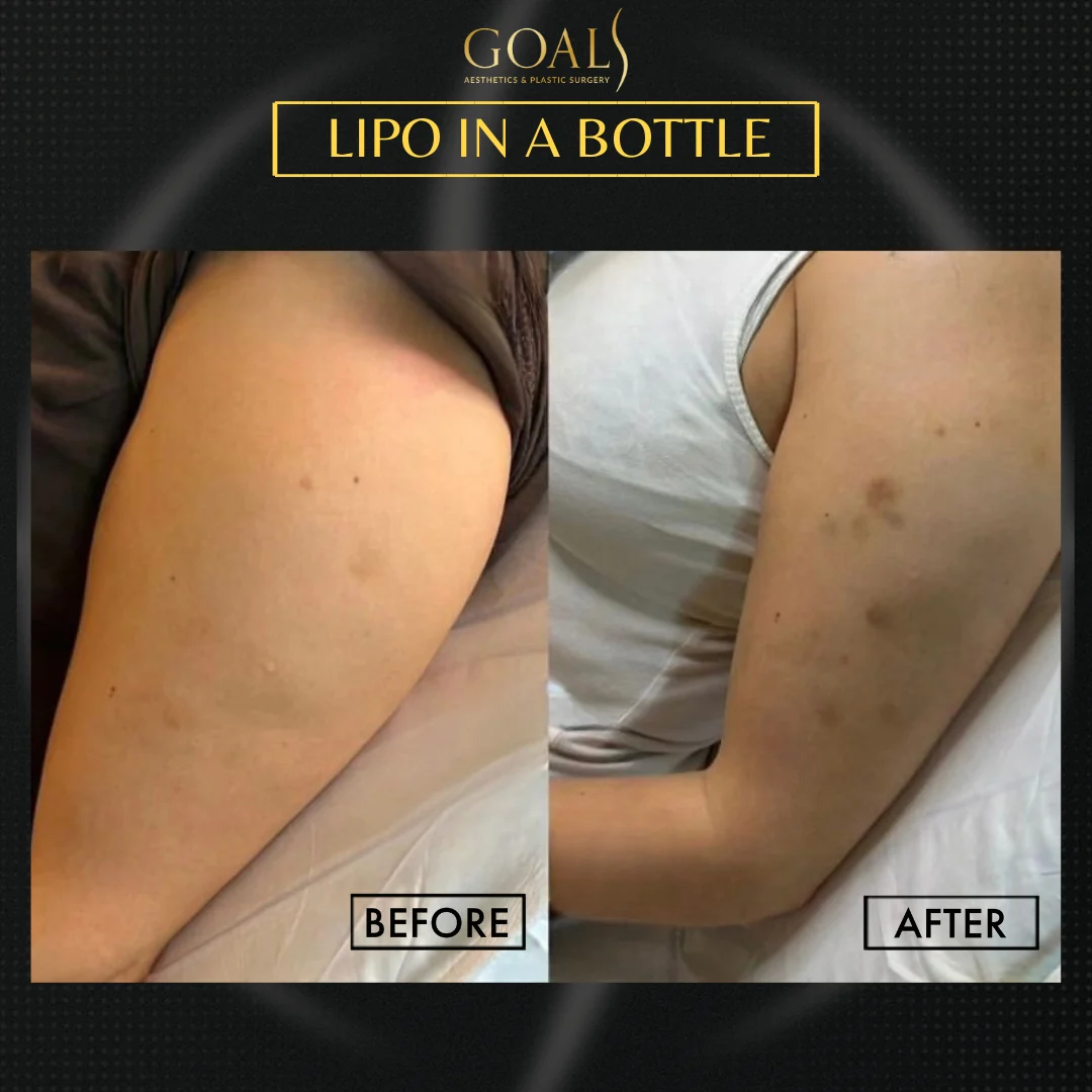 Before and after — Fat Loss Shots, patient 4
