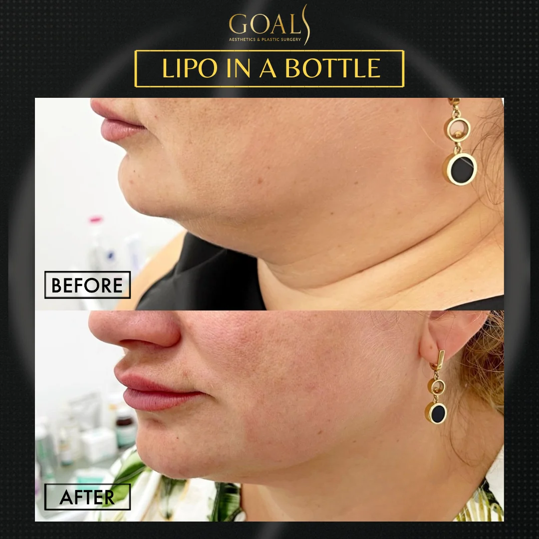 Before and after — Fat Loss Shots, patient 6