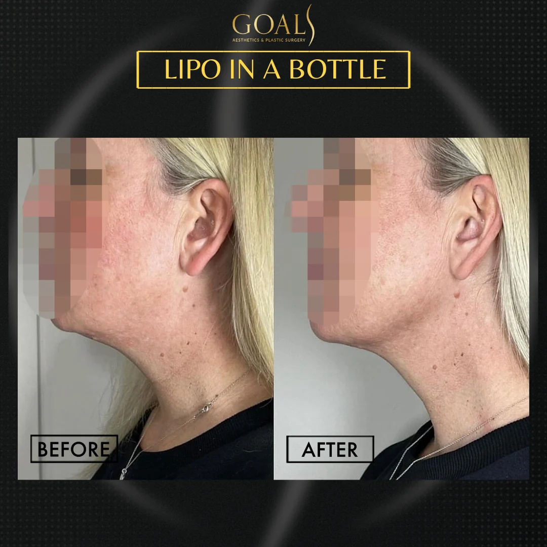 Before and after — Fat Loss Shots · Houston, patient 1