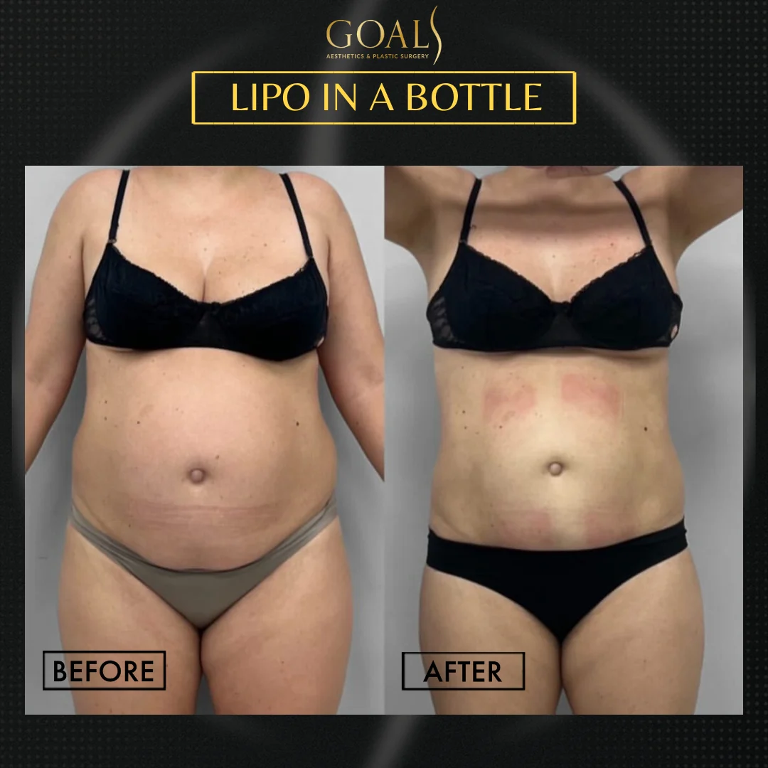 Before and after — Fat Loss Shots · Houston, patient 2