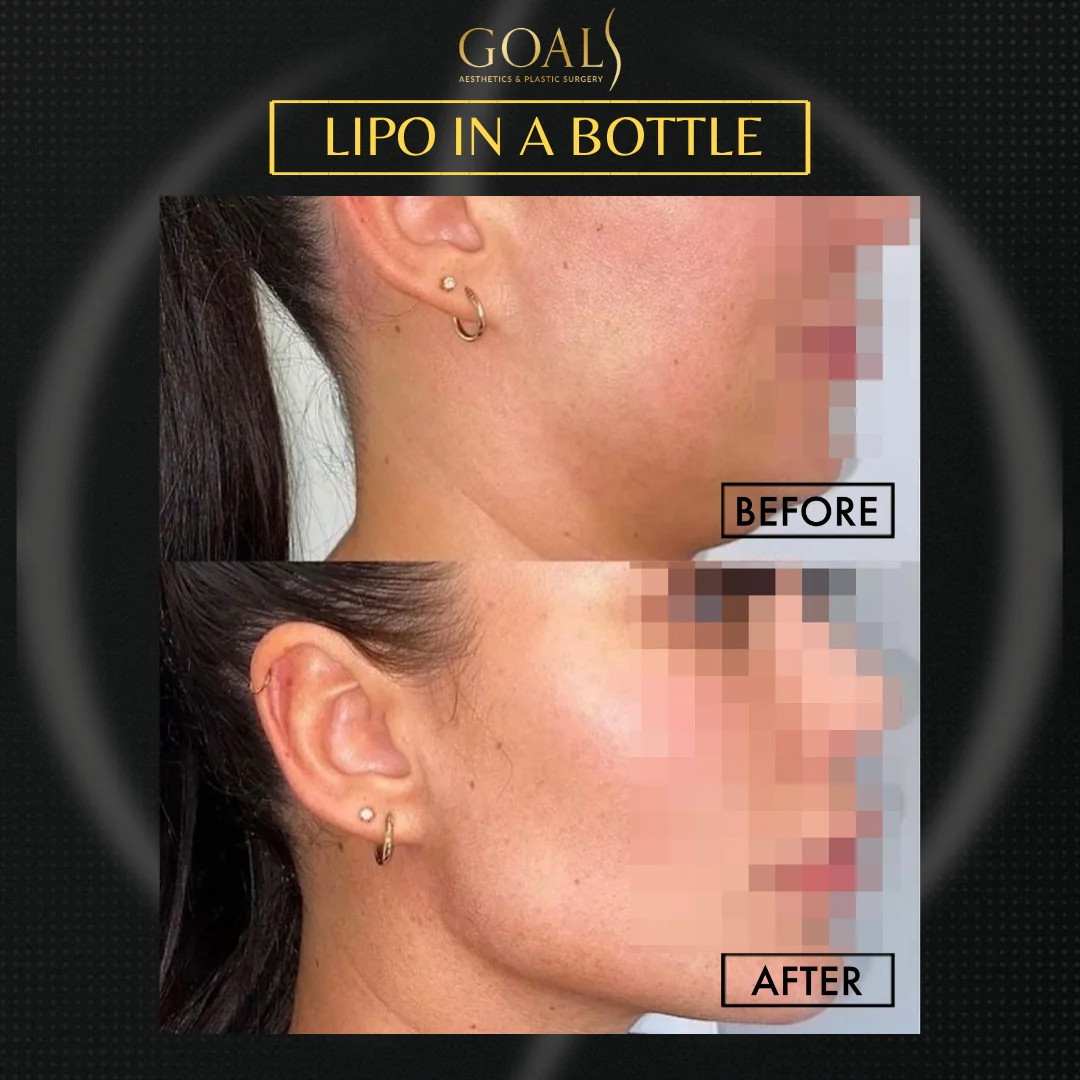 Before and after — Fat Loss Shots, patient 1