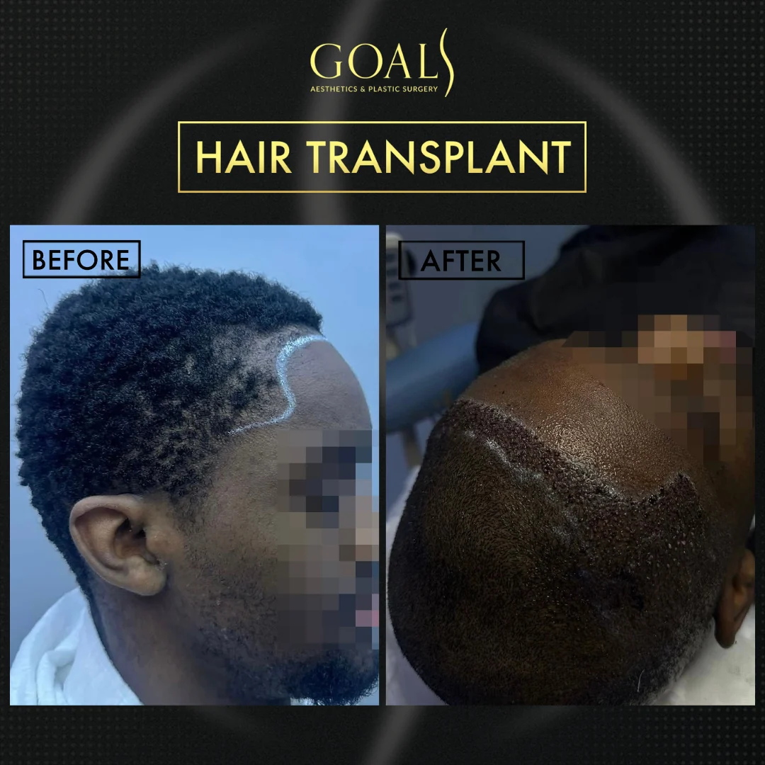Before and after — Men's Hair Transplant · Atlanta Walton St., patient 4
