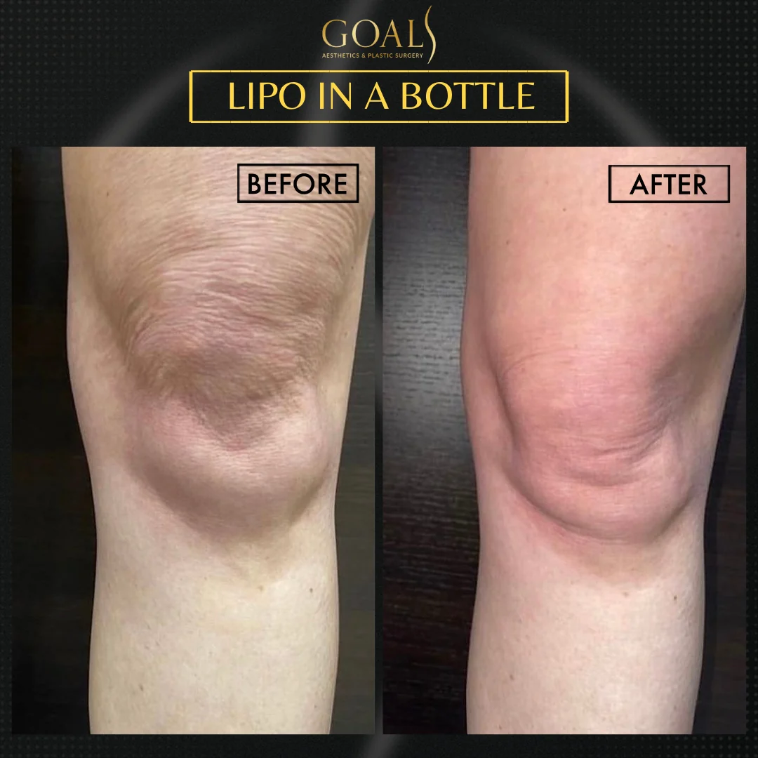 Before and after — Fat Loss Shots, patient 2