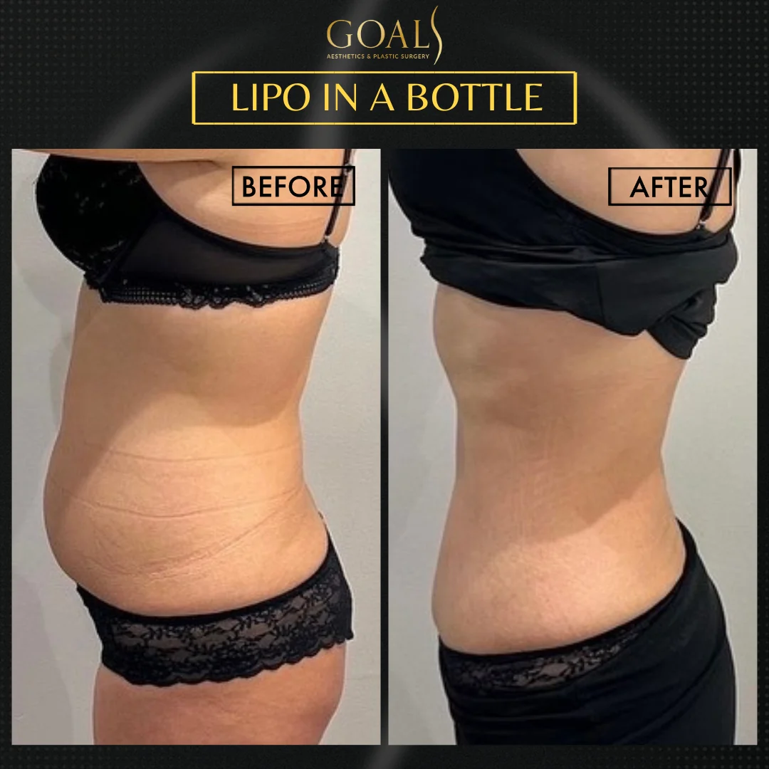 Before and after — Fat Loss Shots · Central Park, patient 1