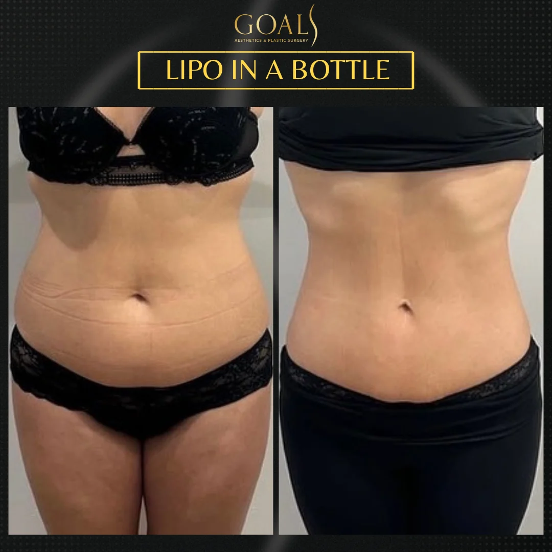 Before and after — Fat Loss Shots · Central Park, patient 2