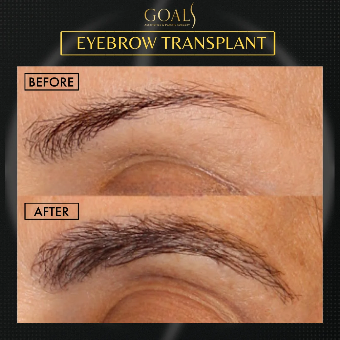 Before and after — Eyebrow Hair Transplant · Atlanta Walton St., patient 1
