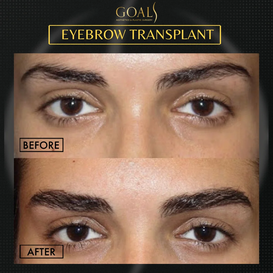 Before and after — Eyebrow Hair Transplant · Atlanta Walton St., patient 2