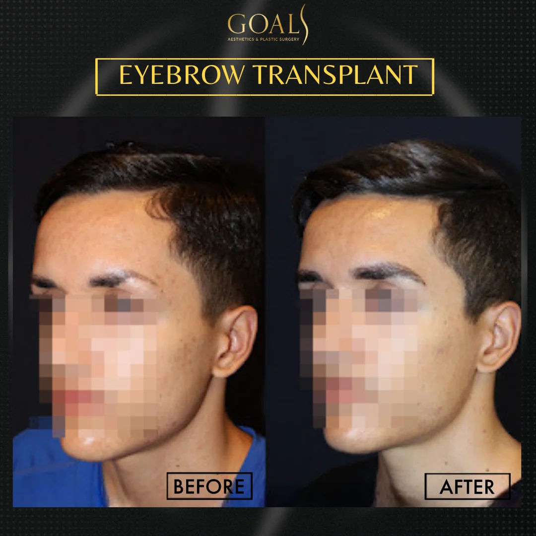 Before and after — Eyebrow Hair Transplant · Atlanta Walton St., patient 3