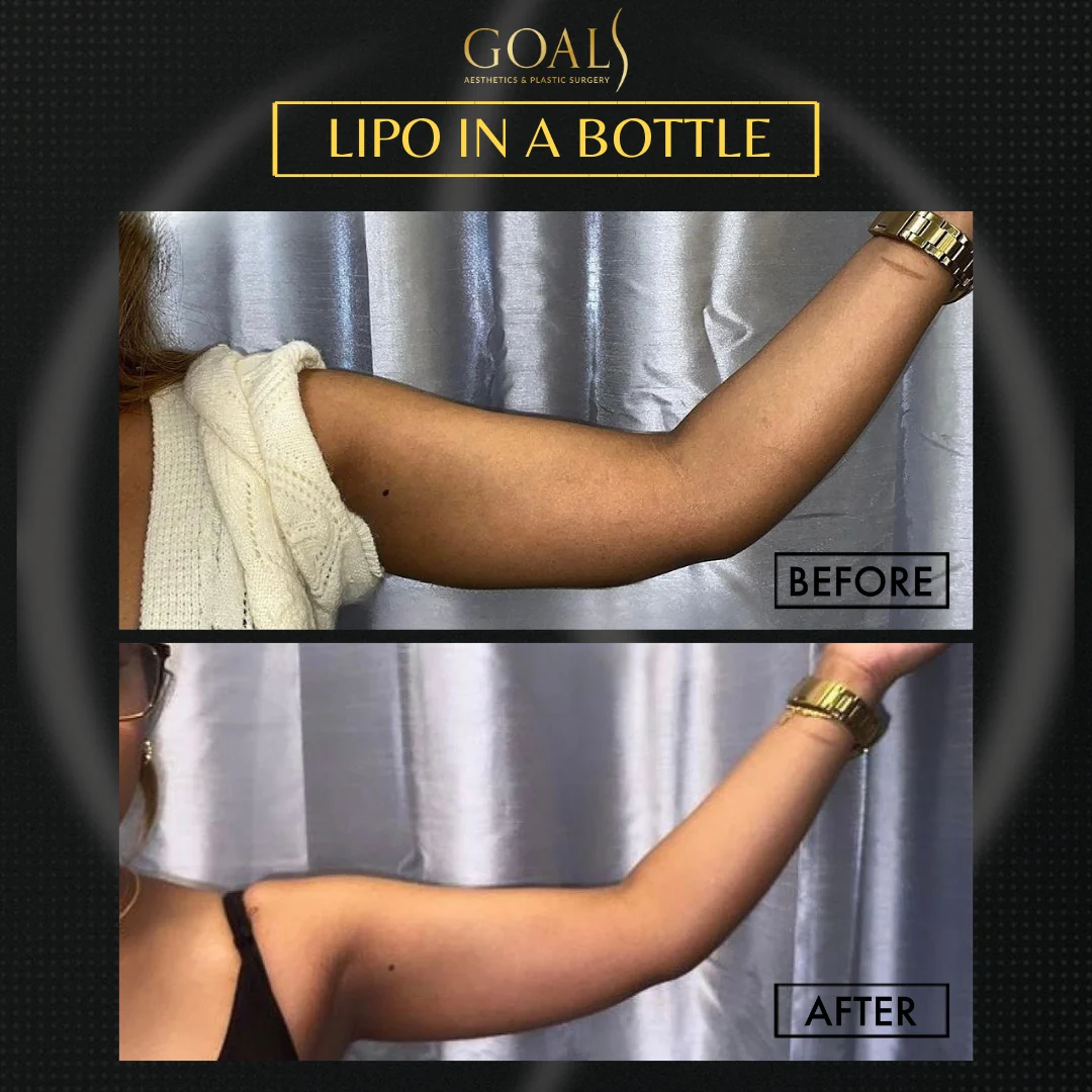 Before and after — Fat Loss Shots · Central Park, patient 3