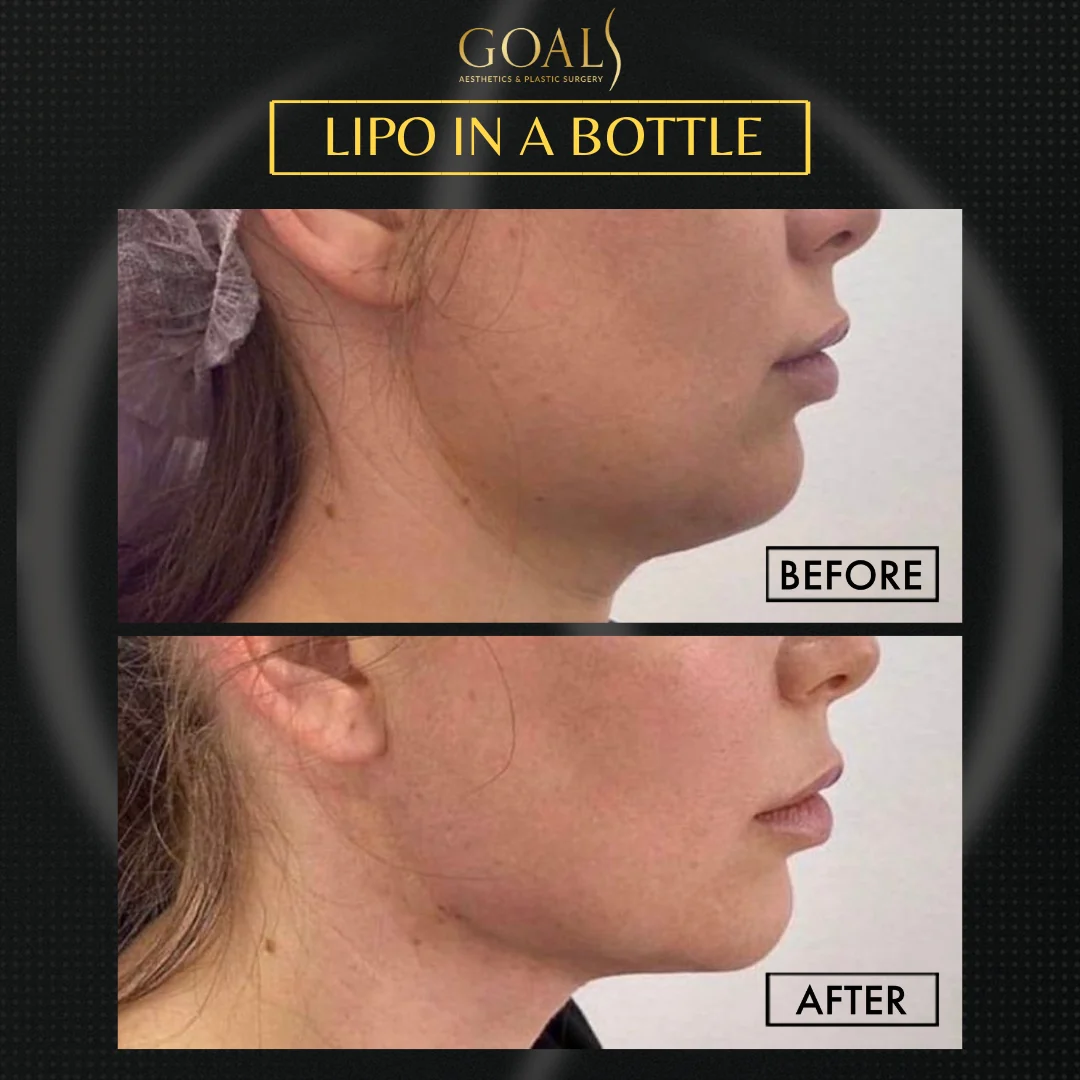 Before and after — Fat Loss Shots · Central Park, patient 4