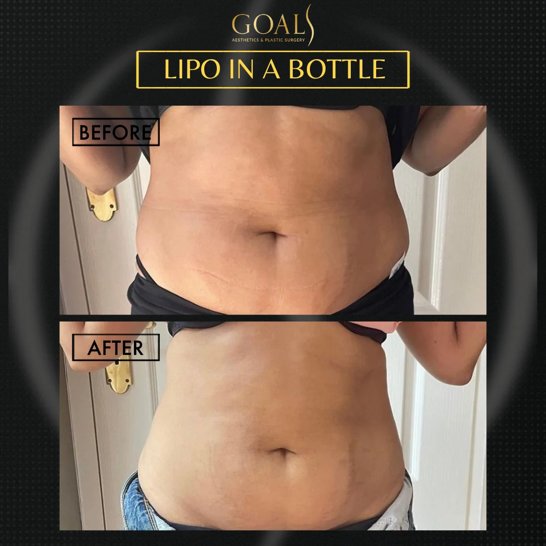 Before and after — Fat Loss Shots · Central Park, patient 5