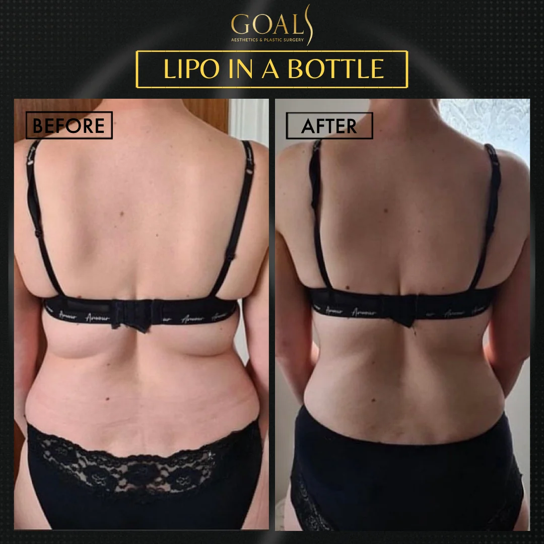 Before and after — Fat Loss Shots · Central Park, patient 6