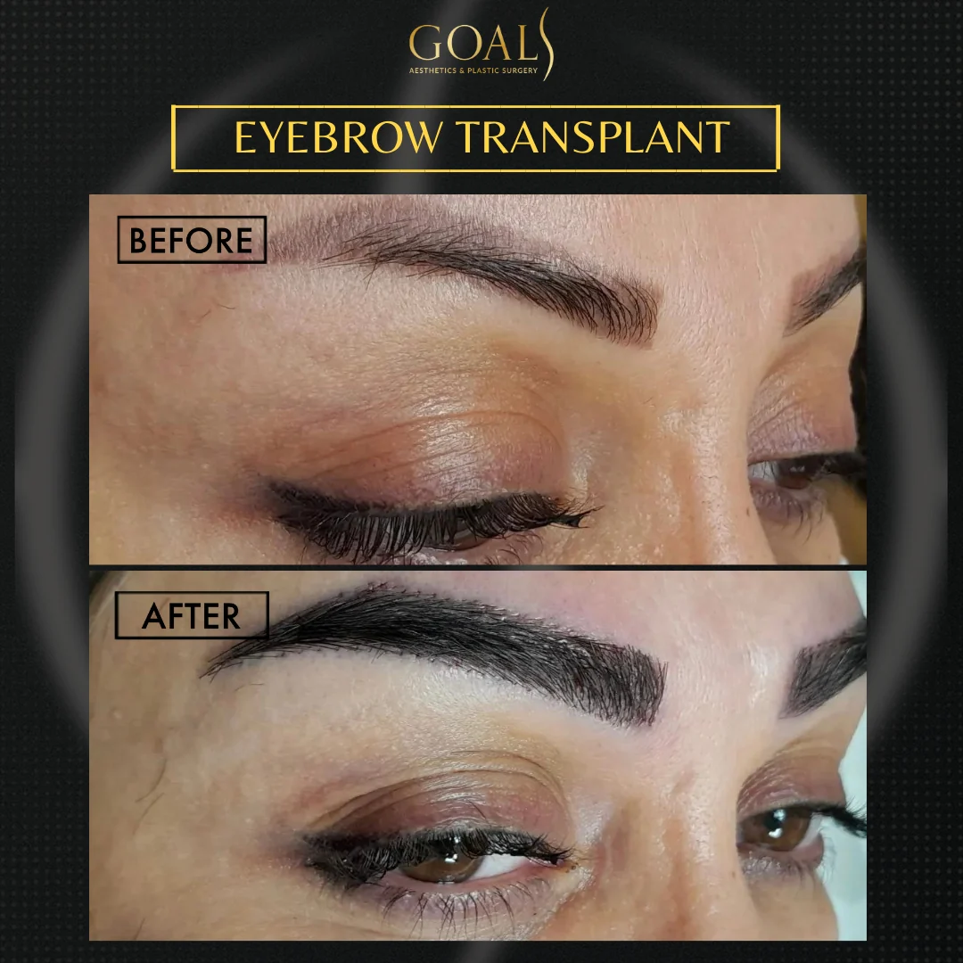 Before and after — Eyebrow Hair Transplant · Atlanta Walton St., patient 4