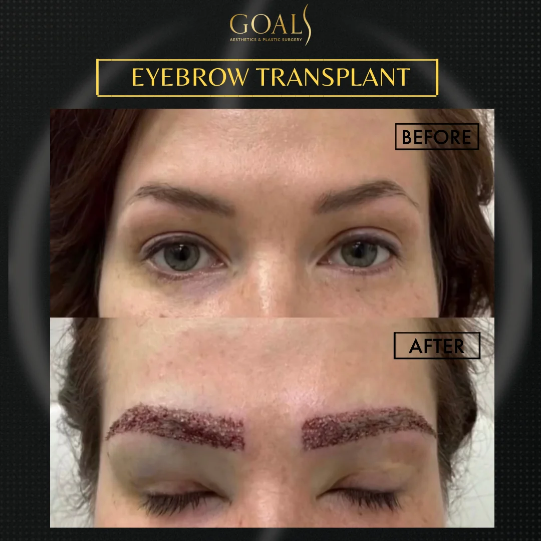 Before and after — Eyebrow Hair Transplant · Atlanta Walton St., patient 5