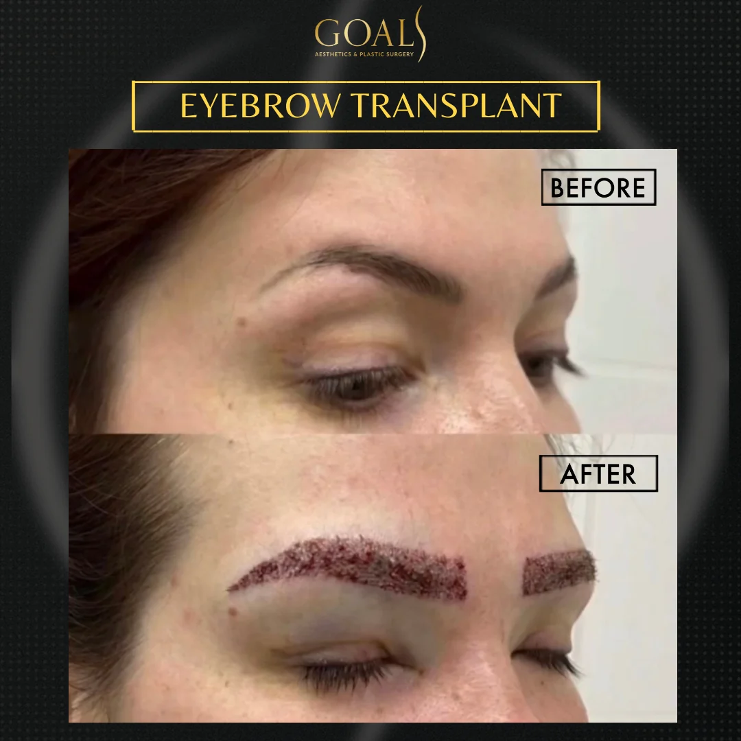 Before and after — Eyebrow Hair Transplant · Atlanta Walton St., patient 6