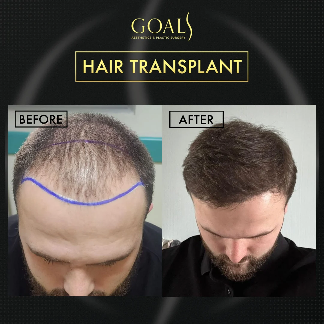 Before and after — Men's Hair Transplant · Atlanta Walton St., patient 5