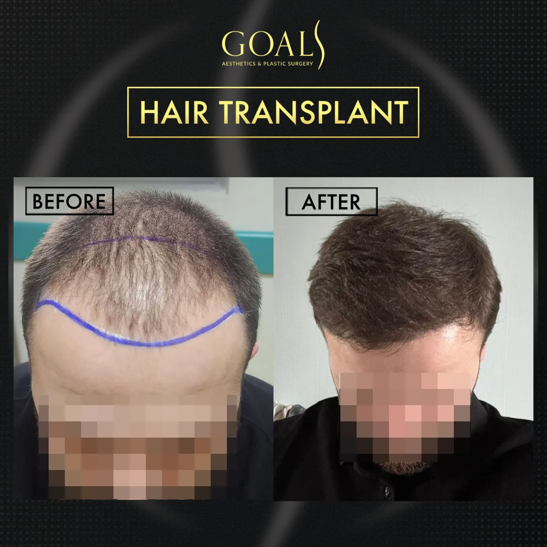 Before and after — Men's Hair Transplant · Atlanta Walton St., patient 6