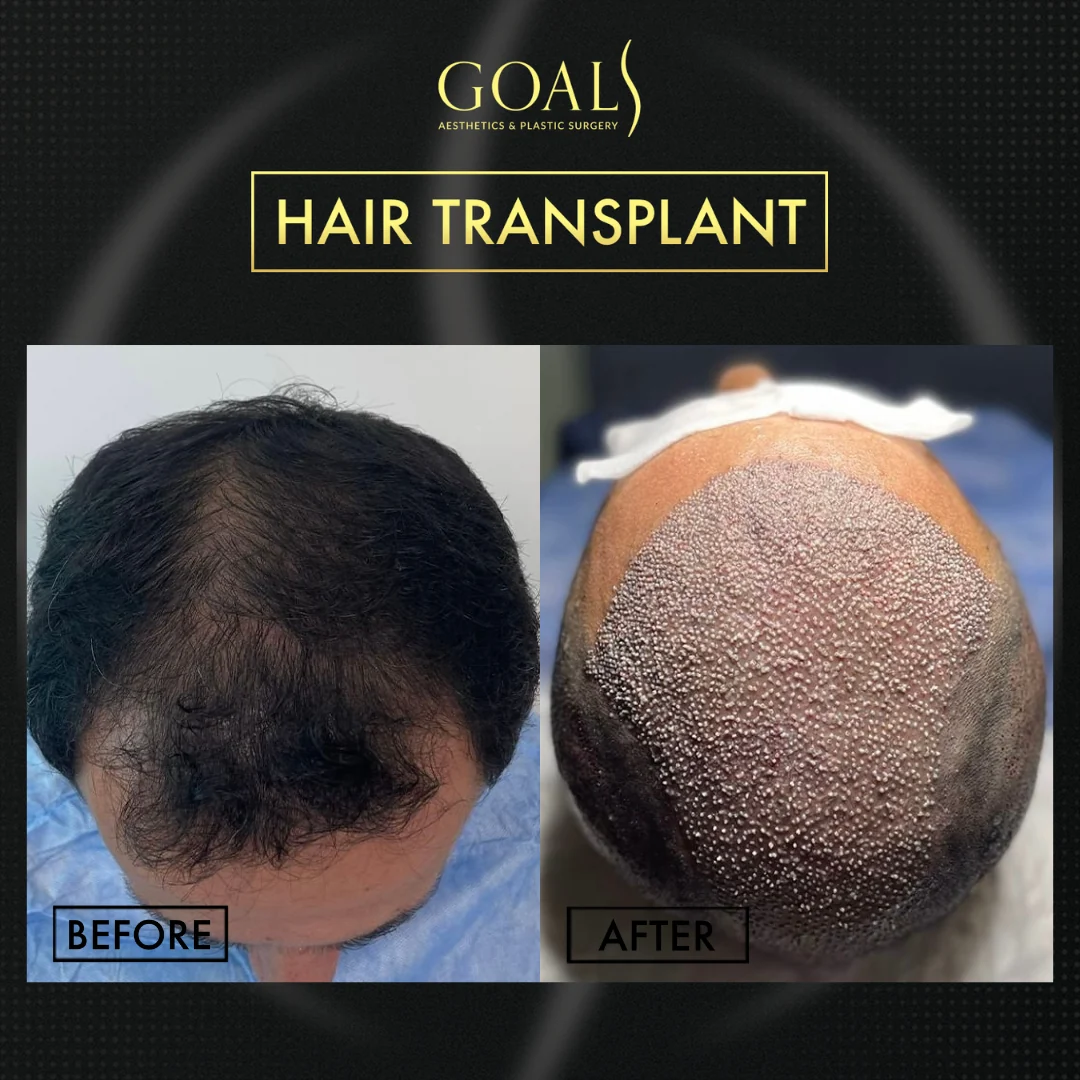 Before and after — FUE Hair Transplant, patient 1