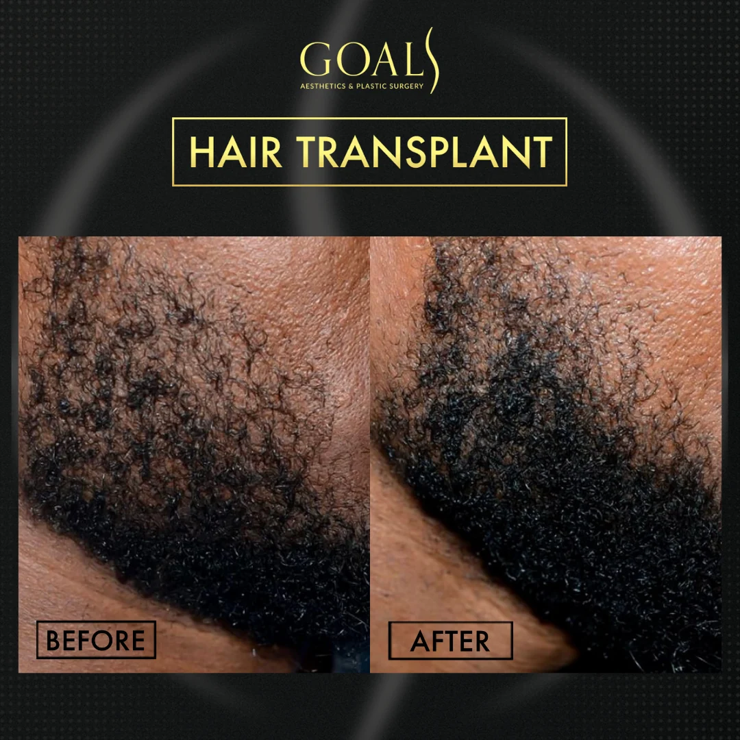 Before and after — FUE Hair Transplant, patient 2