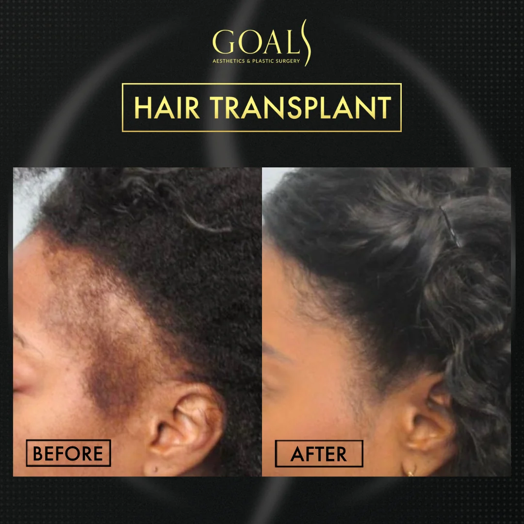 Before and after — FUE Hair Transplant, patient 3