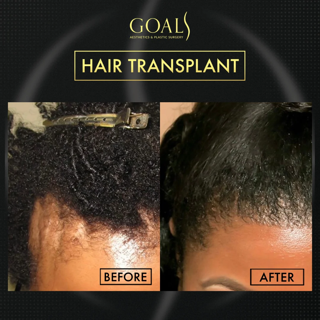 Before and after — FUE Hair Transplant, patient 4