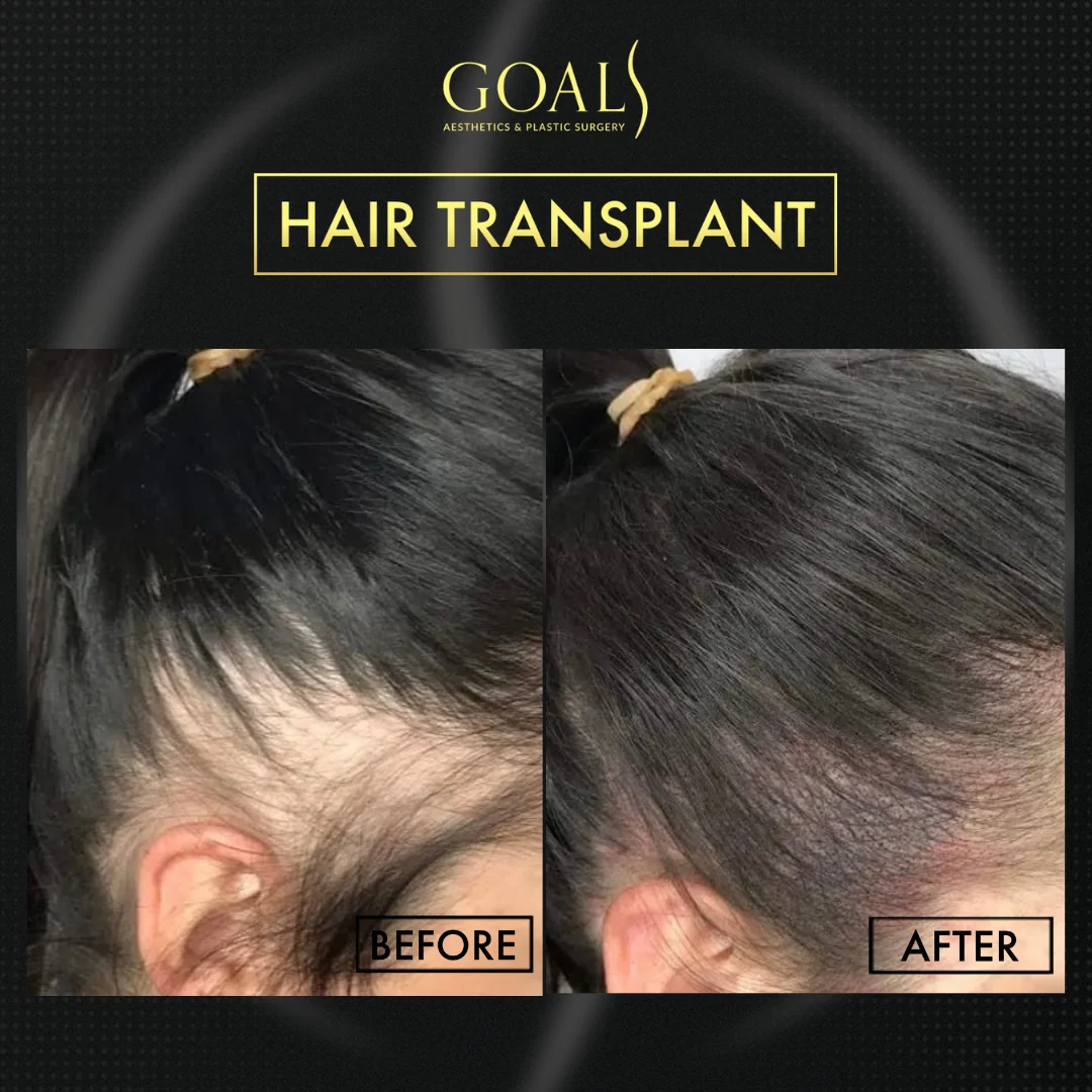 Before and after — FUE Hair Transplant, patient 5