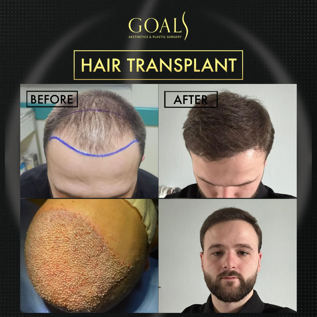 Before and after — FUE Hair Transplant, patient 6