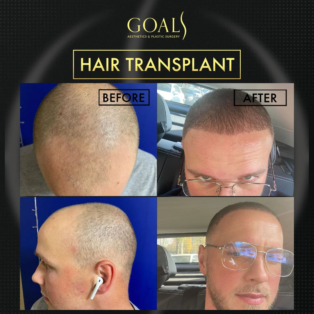 Before and after — Trasplante Capilar para Hombres, patient 1