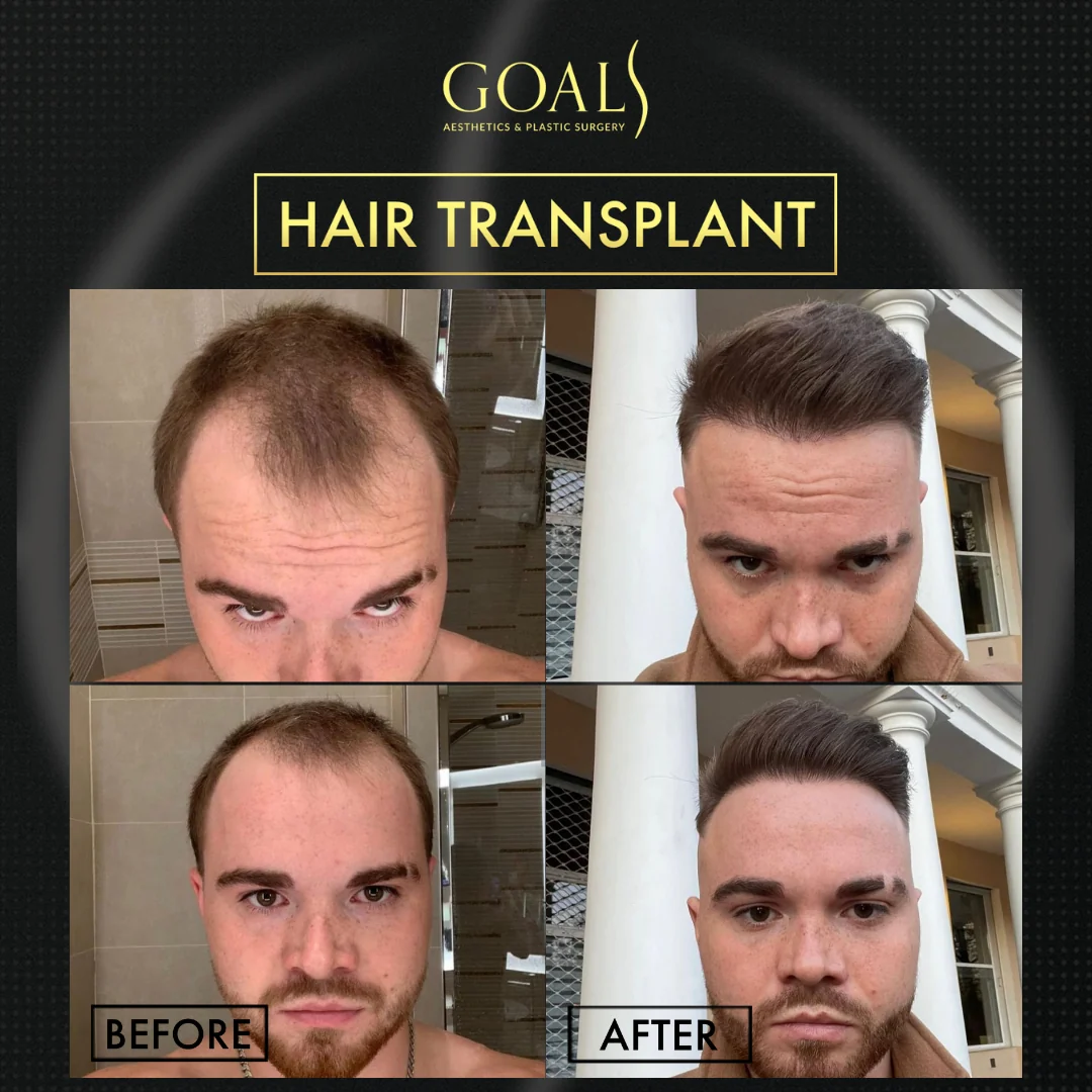 Before and after — Trasplante Capilar para Hombres, patient 2