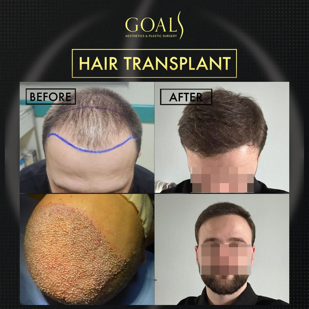Before and after — FUE Hair Transplant · Atlanta Walton St., patient 2