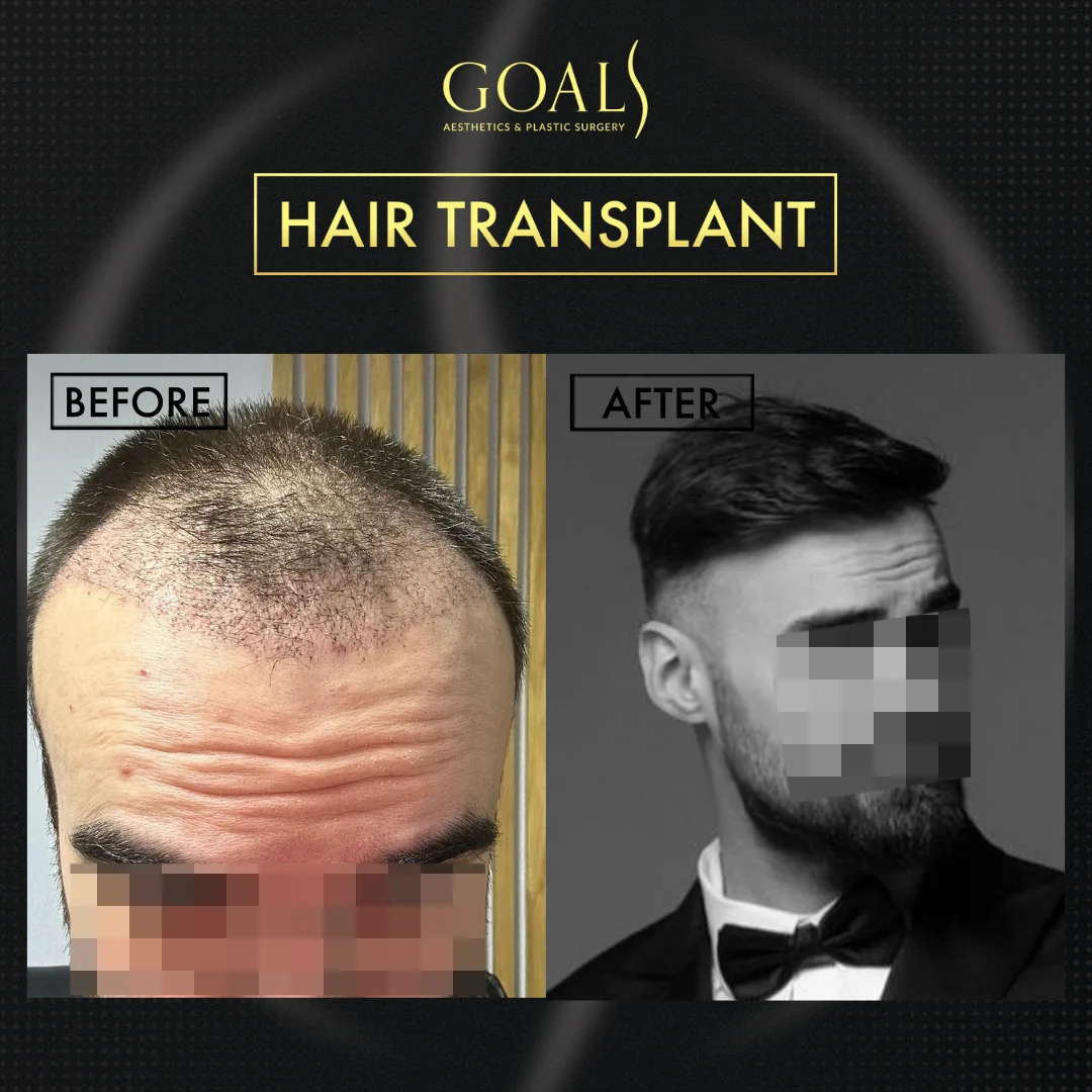 Before and after — FUE Hair Transplant · Atlanta Walton St., patient 3