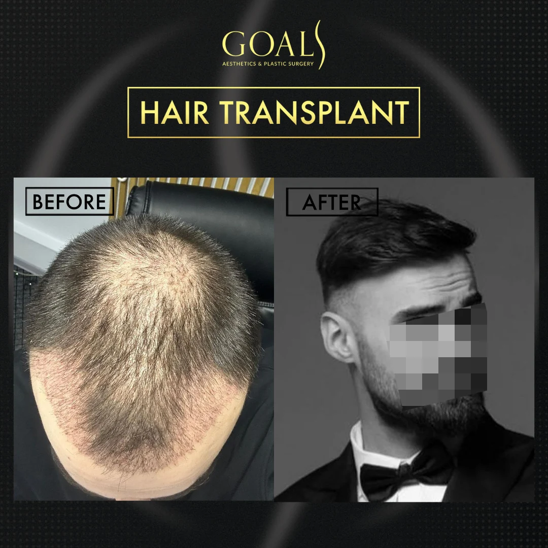 Before and after — FUE Hair Transplant · Atlanta Walton St., patient 4