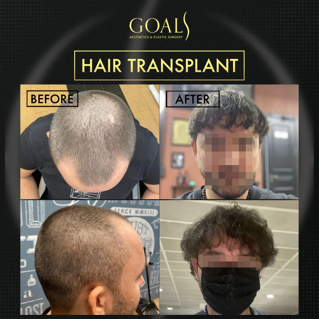 Before and after — FUE Hair Transplant · Atlanta Walton St., patient 5