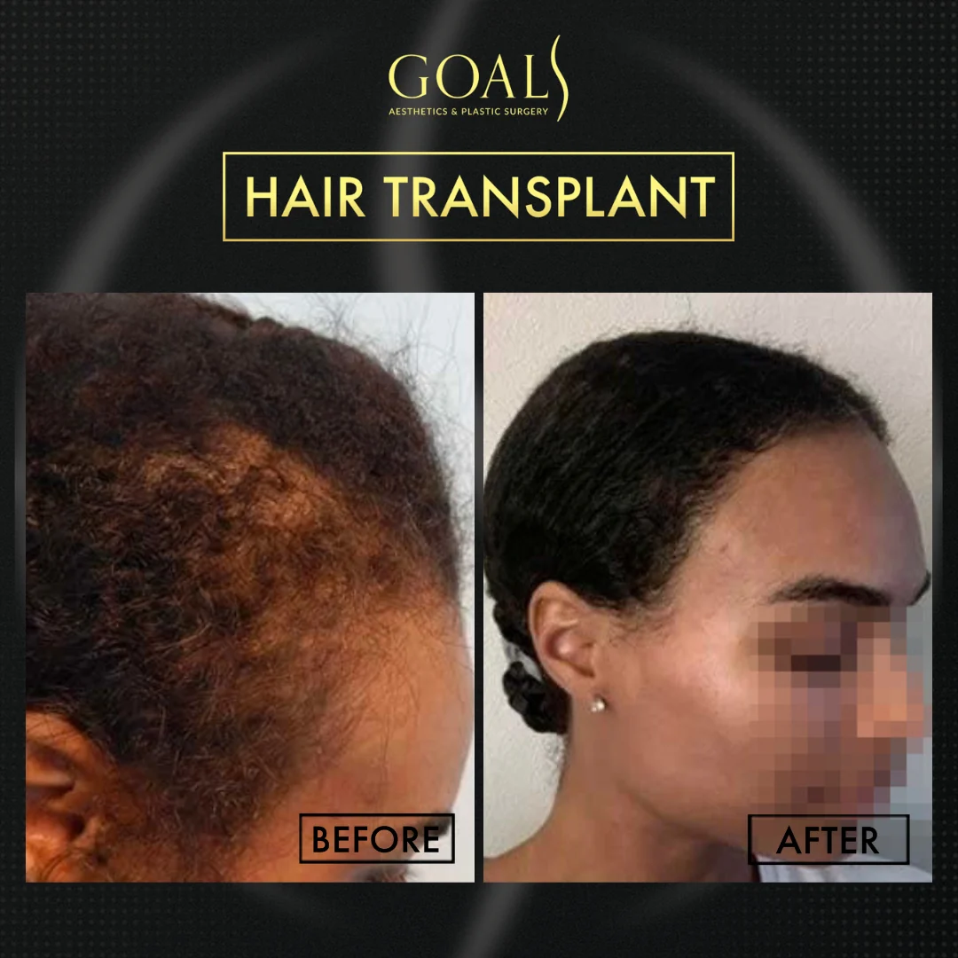 Before and after — Trasplante Capilar Afro, patient 1