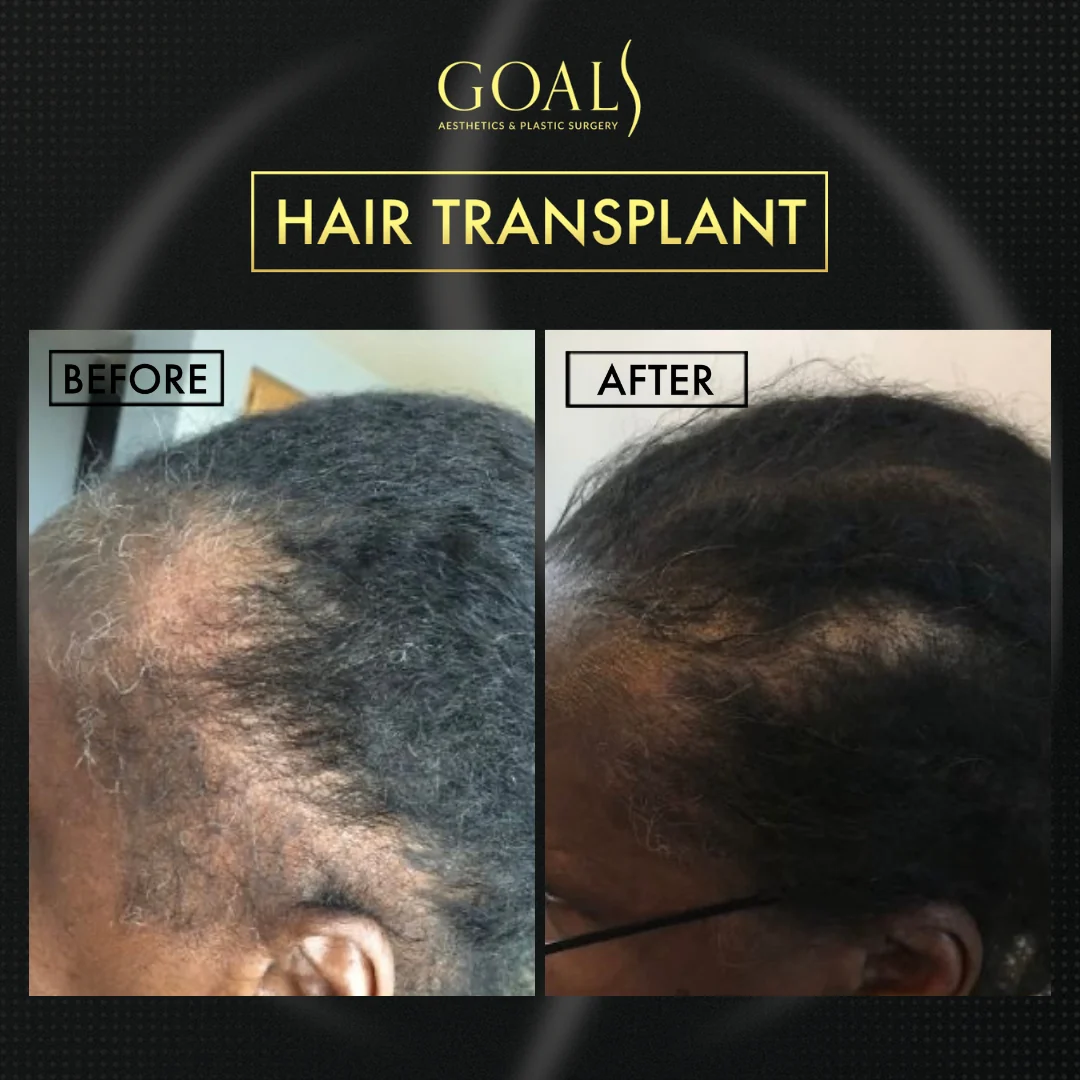 Before and after — Trasplante Capilar Afro, patient 2