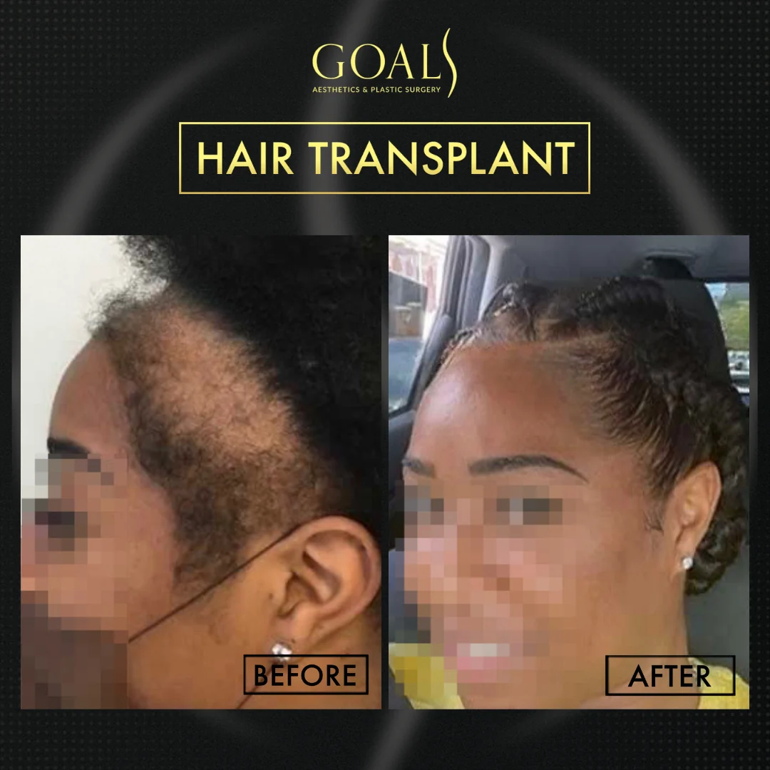 Before and after — Trasplante Capilar Afro, patient 3