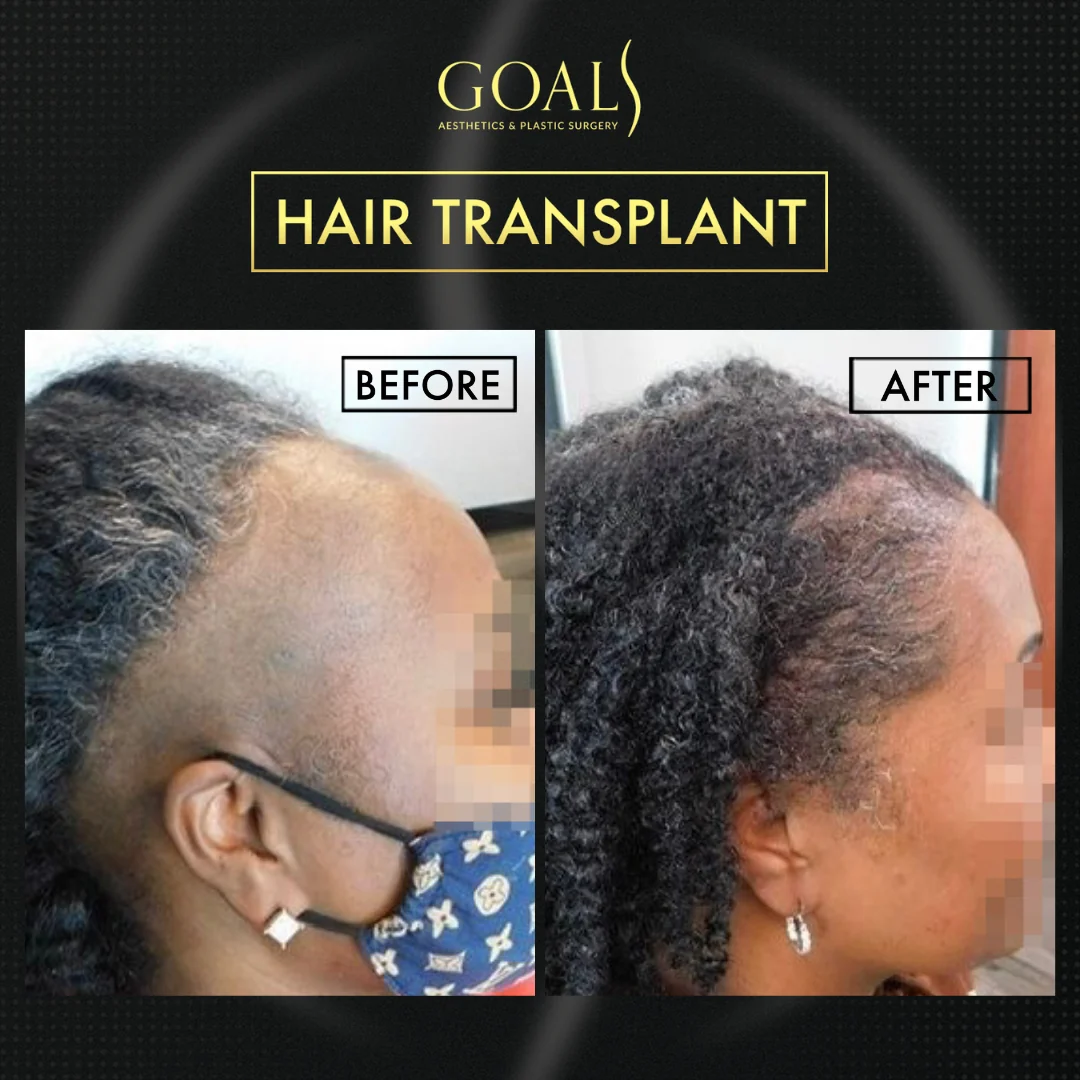 Before and after — Trasplante Capilar Afro, patient 4