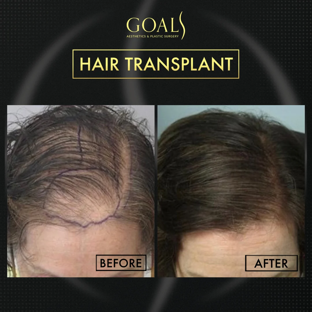 Before and after — Trasplante Capilar Afro, patient 6