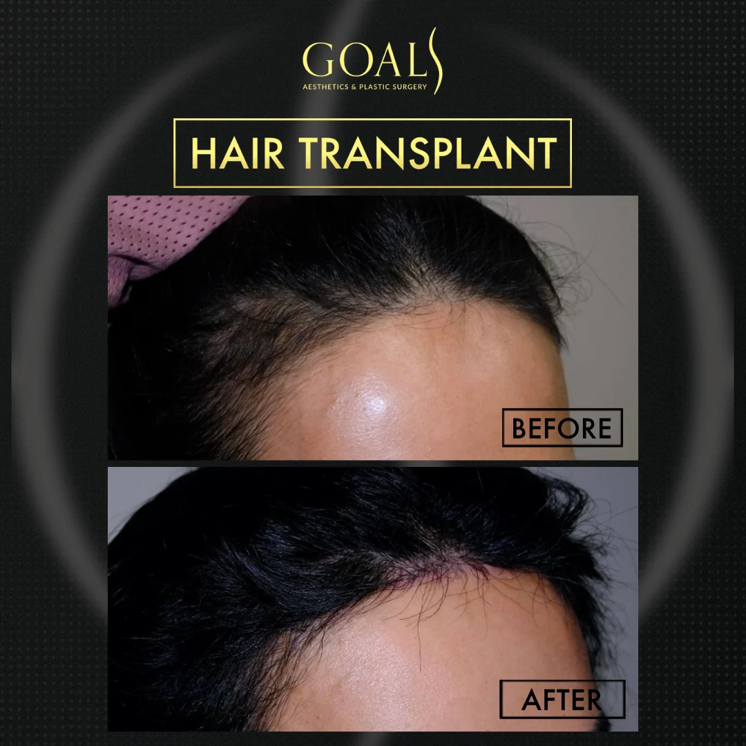 Before and after — Afro Hair Transplant · Atlanta Walton St., patient 1