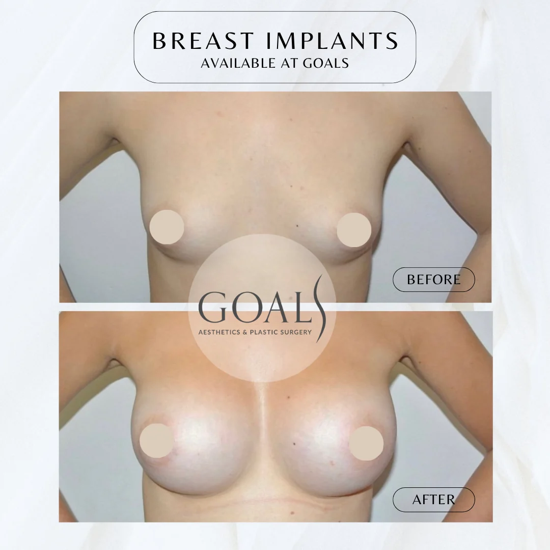 Before and after — Breast Augmentation · Harlem, patient 4