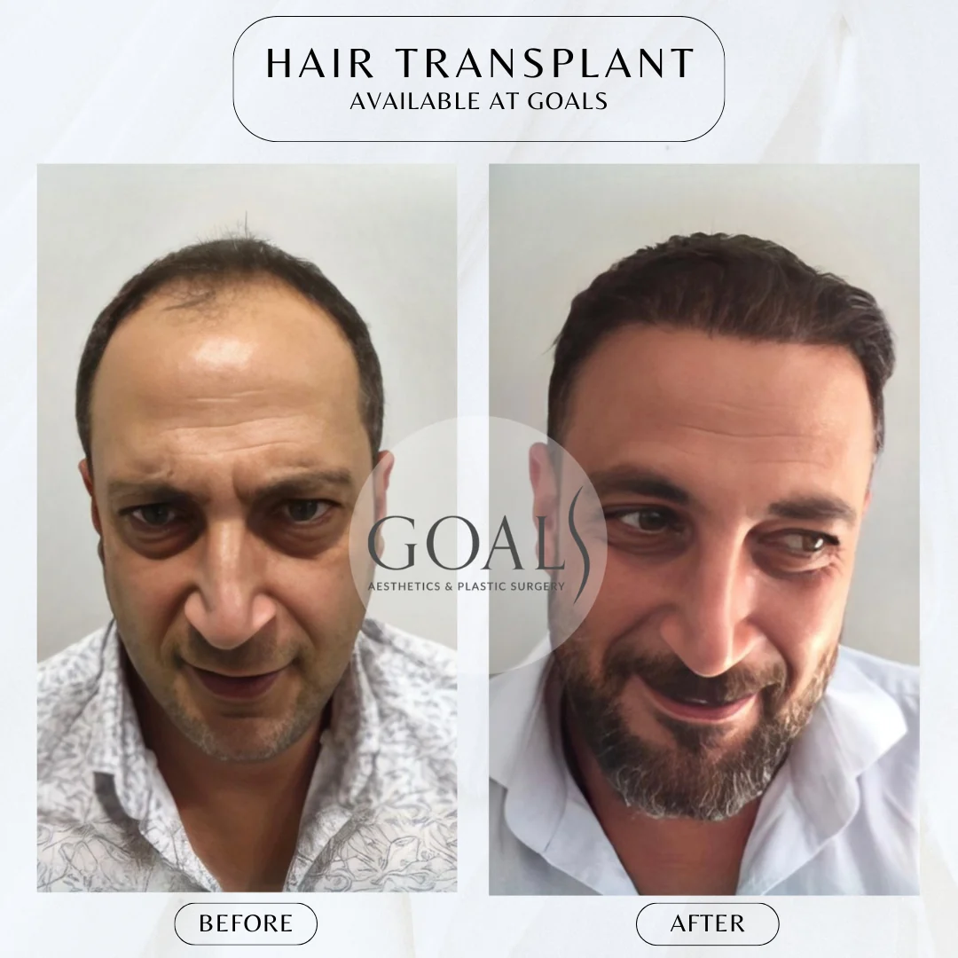 Before and after — Beard & Facial Hair Transplant, patient 3