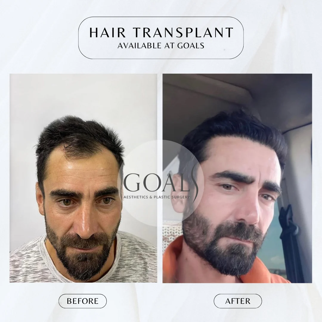 Before and after — Beard & Facial Hair Transplant, patient 1