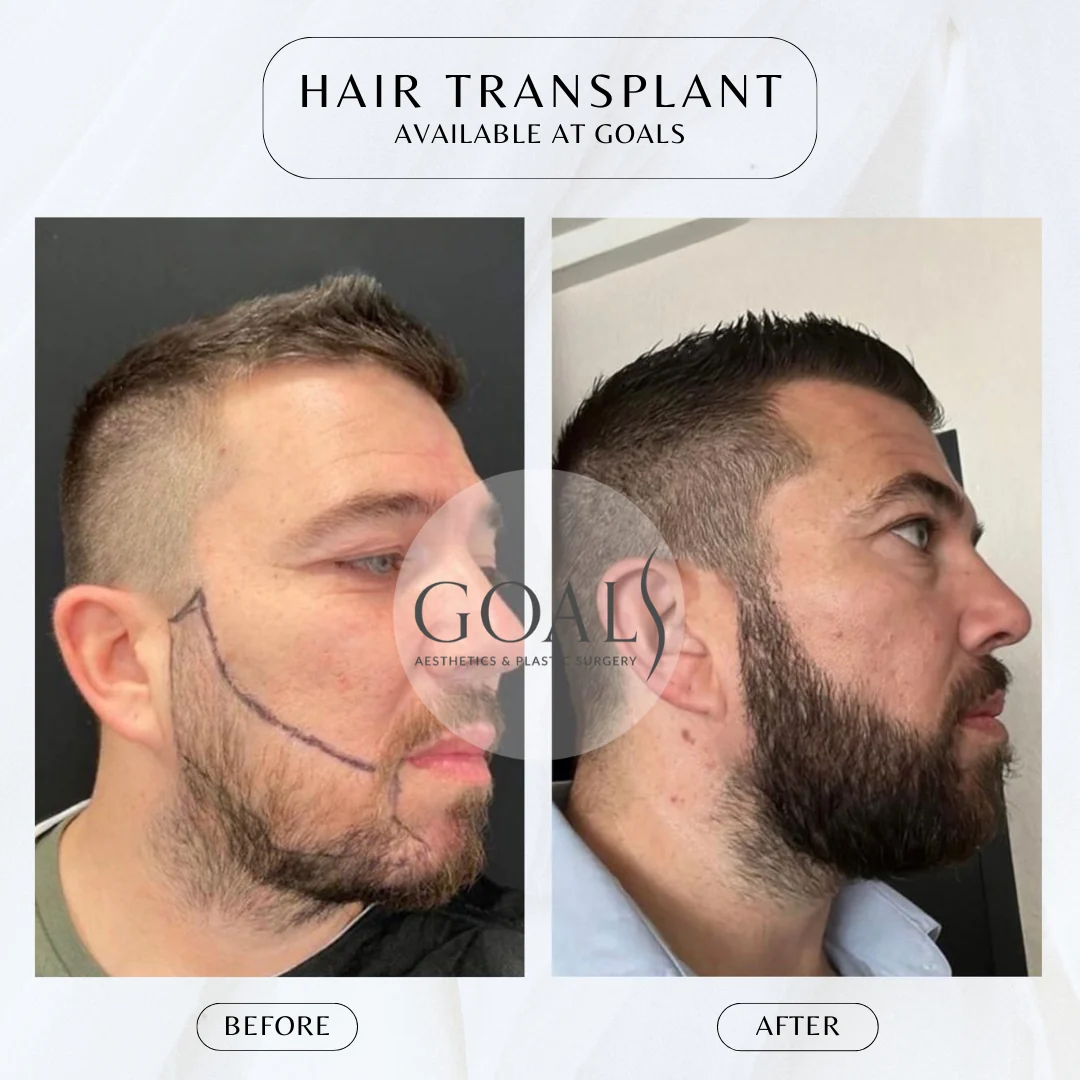 Before and after — Beard & Facial Hair Transplant, patient 2