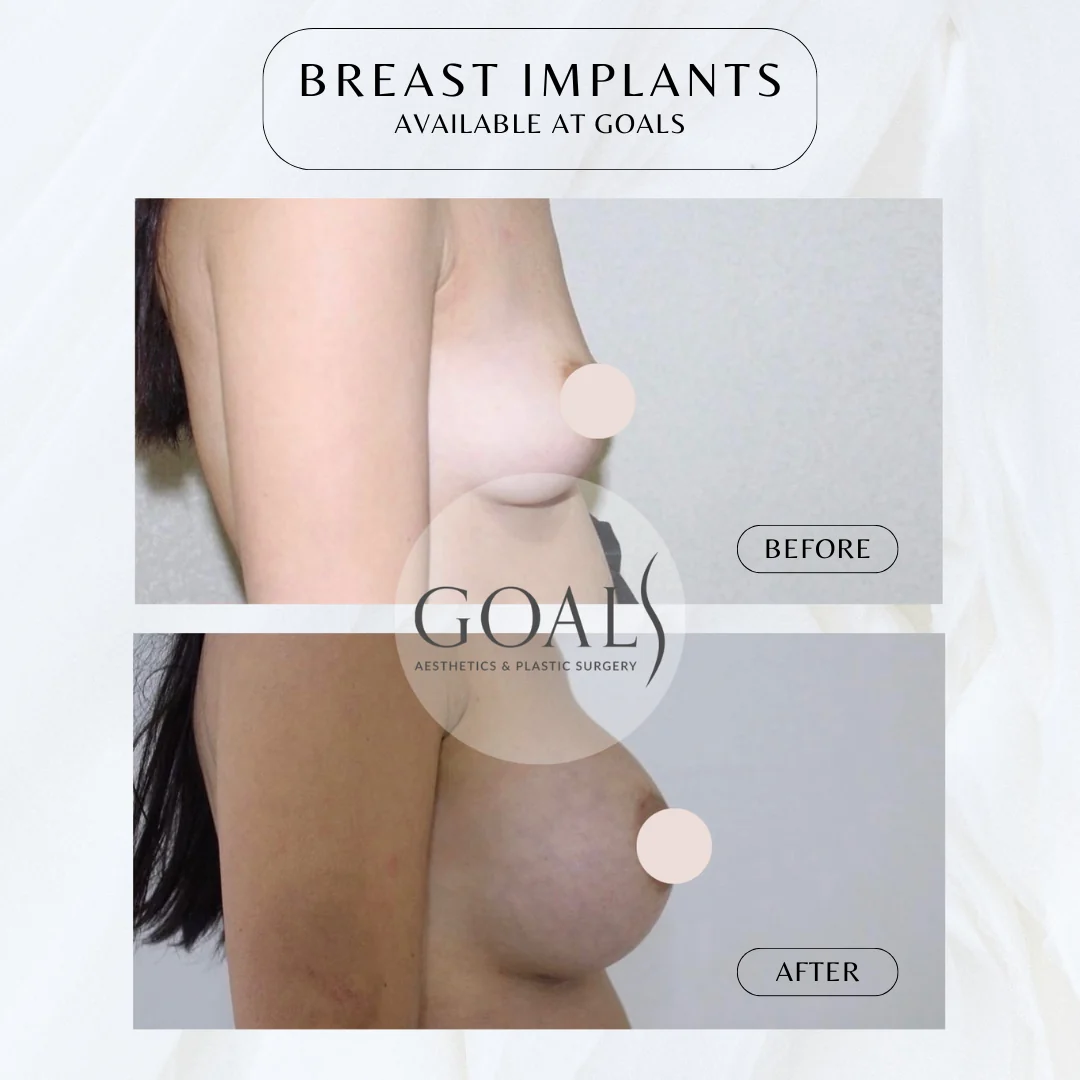 Before and after — Breast Augmentation · Gaithersburg, patient 3