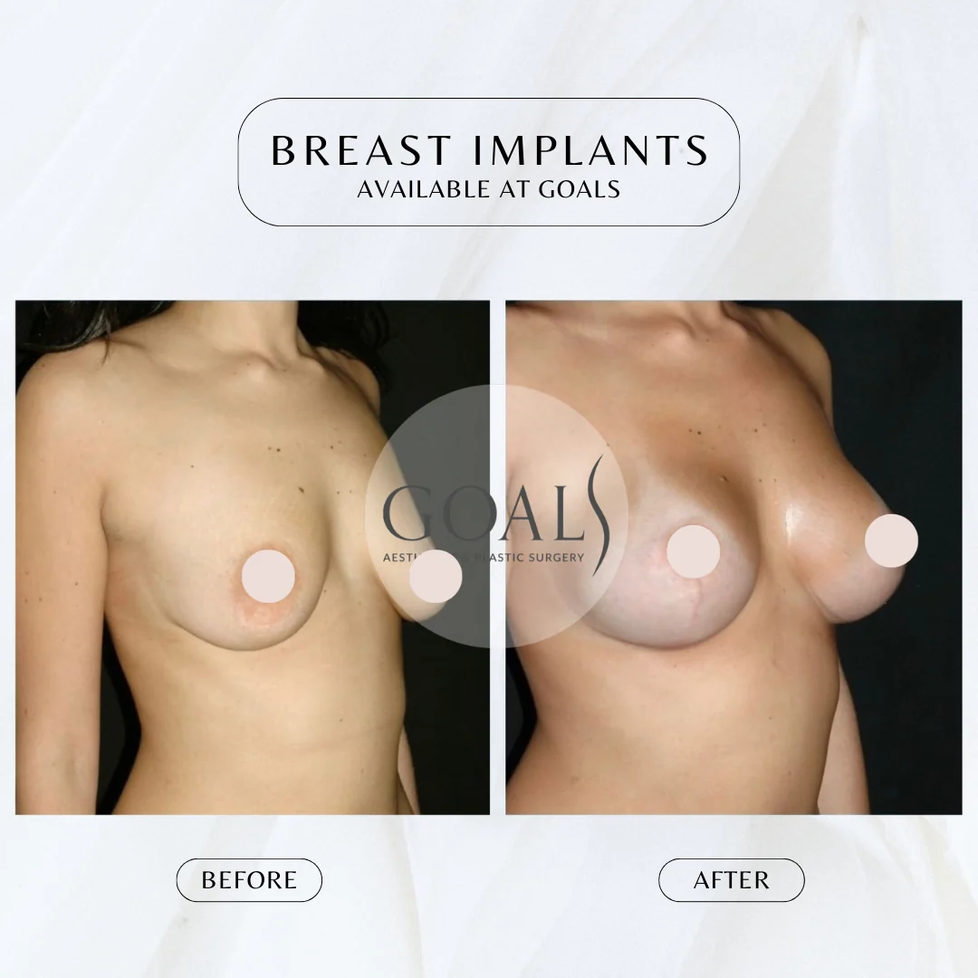 Before and after — Breast Augmentation · Gaithersburg, patient 4