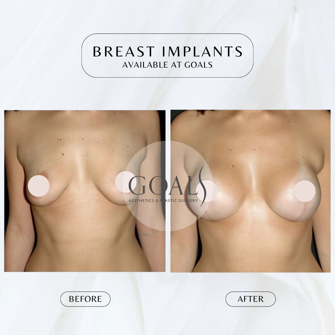 Before and after — Breast Augmentation · Gaithersburg, patient 5